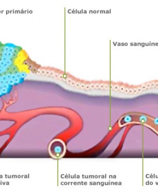 Cancro 3